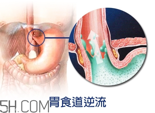 胃食道逆流怎么辦 質(zhì)子泵抑制劑風(fēng)險(xiǎn)高