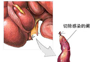 闌尾手術(shù)會影響結(jié)腸嗎？闌尾手術(shù)術(shù)后要注意什么？