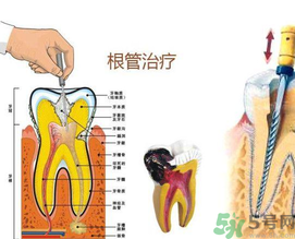 什么是根管治療？為什么牙齒疼要做根管治療？