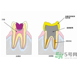 什么是根管治療？為什么牙齒疼要做根管治療？