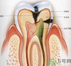 什么是根管治療？為什么牙齒疼要做根管治療？