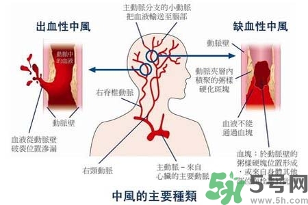 腦中風是什么？腦中風的癥狀？