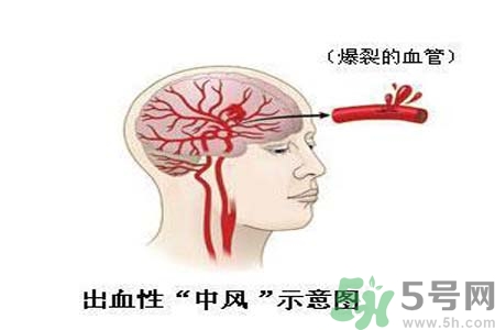 腦中風的護理措施？腦中風的飲食護理？