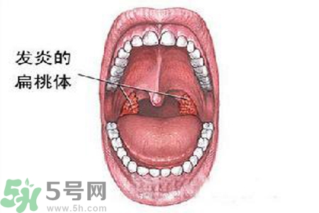 慢性咽炎是什么？慢性咽炎的癥狀有哪些？