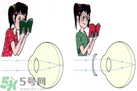 近視眼的發(fā)病因素？近視眼的并發(fā)癥有哪些？