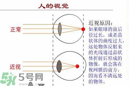 近視眼高發(fā)人群？如何預(yù)防近視眼？