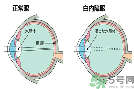 白內(nèi)障治療方法是什么？白內(nèi)障可以用什么藥物治療？