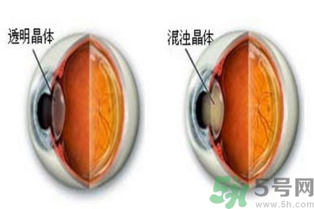 白內(nèi)障治療方法是什么？白內(nèi)障可以用什么藥物治療？