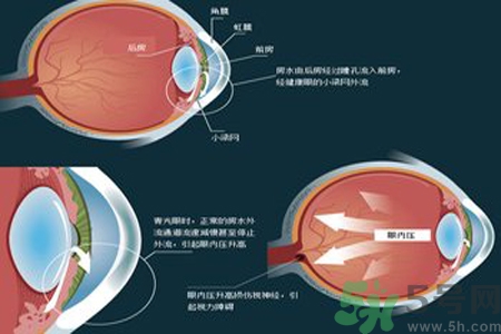 青光眼是什么？青光眼癥狀有什么？