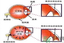 青光眼的發(fā)病因素是什么？青光眼的并發(fā)癥有哪些？