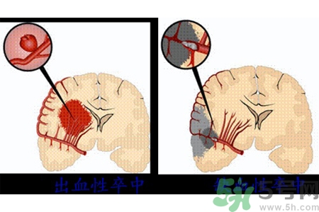 腦出血的發(fā)病因素是什么？腦出血的并發(fā)癥有哪些？