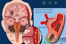 腦出血的發(fā)病因素是什么？腦出血的并發(fā)癥有哪些？