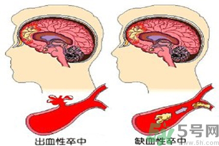 腦出血的治療方法是什么？腦出血可以用哪些藥物治療？