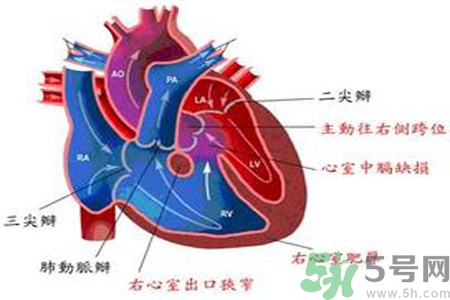 先天性心臟病發(fā)病原因是什么？