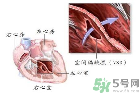 心臟病是怎么形成的？易發(fā)人群有哪些？