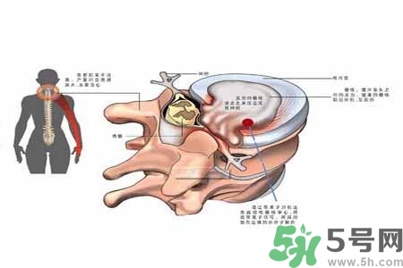 為什么年輕人容易得頸椎??？頸椎病嚴重的癥狀有哪些？