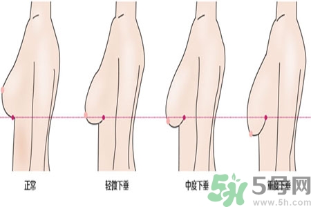 ?女性乳房下垂的原因是什么？女性乳房下垂的分類有哪些？