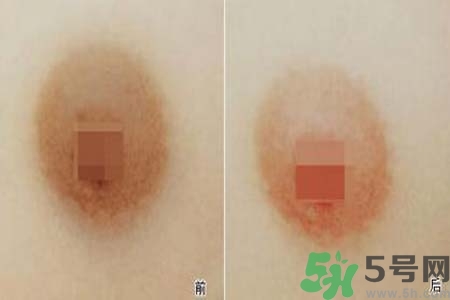 乳頭發(fā)黑怎么辦？怎么樣可以使乳頭變白？