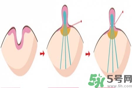 乳頭內(nèi)陷怎么辦？乳頭內(nèi)陷的癥狀有哪些？