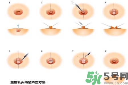 乳頭內(nèi)陷怎么辦？乳頭內(nèi)陷的癥狀有哪些？