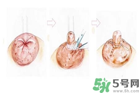 乳頭內(nèi)陷怎么辦？乳頭內(nèi)陷的癥狀有哪些？