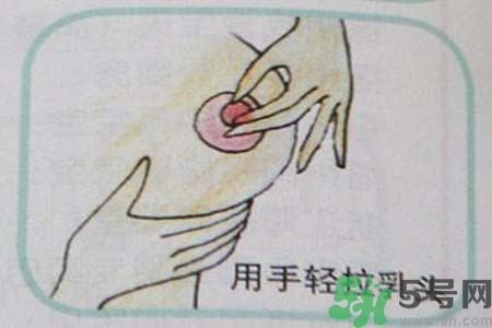 乳頭內(nèi)陷怎么辦？乳頭內(nèi)陷的癥狀有哪些？