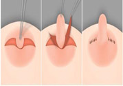 乳頭內(nèi)陷怎么辦？乳頭內(nèi)陷的癥狀有哪些？