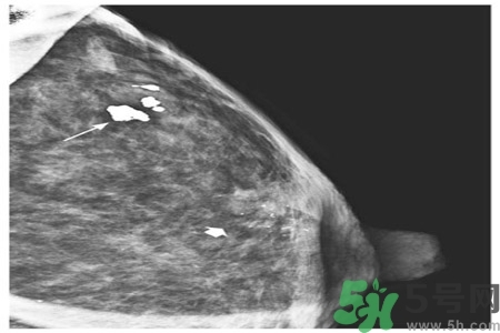 乳腺增生鈣化是什么？乳腺鈣化的癥狀有哪些？