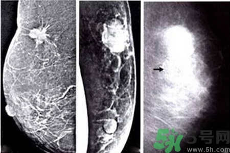 乳腺增生鈣化是什么？乳腺鈣化的癥狀有哪些？