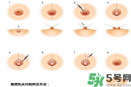 乳頭內(nèi)陷怎么矯正？乳頭內(nèi)陷矯正方法是什么？