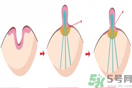 乳頭內(nèi)陷矯正需注意什么？乳頭內(nèi)陷如何預(yù)防？