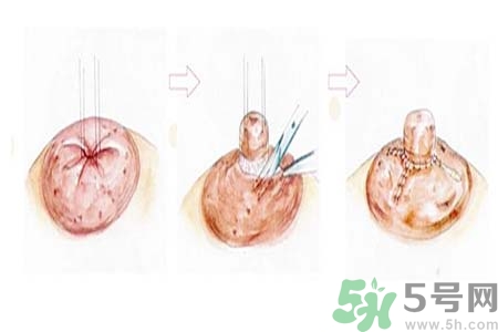 乳頭內(nèi)陷矯正需注意什么？乳頭內(nèi)陷如何預(yù)防？