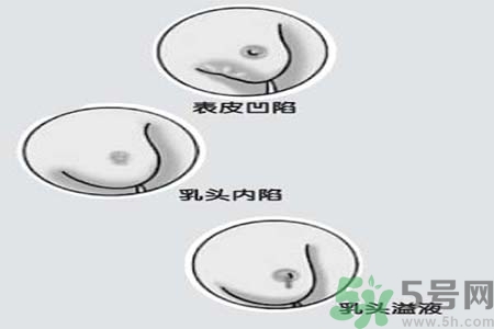 乳頭內(nèi)陷矯正需注意什么？乳頭內(nèi)陷如何預(yù)防？