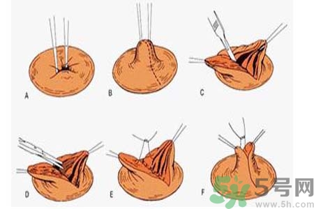 乳頭內(nèi)陷可以拔罐嗎？乳頭內(nèi)陷需要手術(shù)治療嗎？