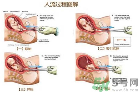 人工流產(chǎn)后多久可以再次懷孕？流產(chǎn)后需要注意什么？