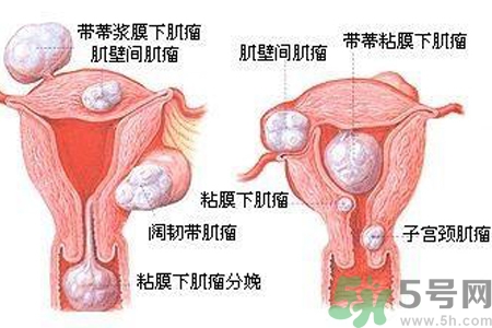 ?子宮移位怎么治療？子宮移位能懷孕嗎？