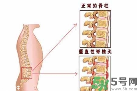 僵直性脊椎炎的癥狀有哪些？怎樣預(yù)防僵直性脊椎炎？