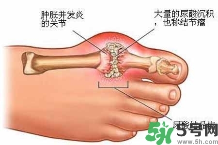 引發(fā)痛風(fēng)的原因是什么？痛風(fēng)病人飲食需注意什么好？