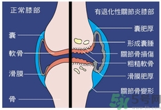 骨關(guān)節(jié)炎能治好嗎？骨關(guān)節(jié)炎平時(shí)注意事項(xiàng)