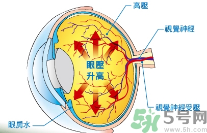 青光眼可以治愈嗎？青光眼怎樣治療？