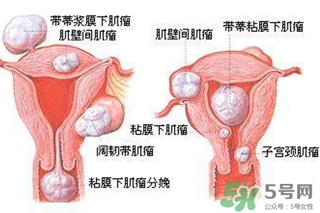 子宮小會影響生育嗎？子宮小會導致不孕嗎？