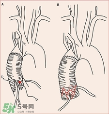 人造血管可以用多久?人造血管的護(hù)理