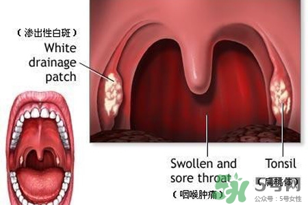 口含大蒜能治療咽炎嗎？巧用大蒜治療咽炎咳嗽