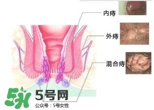 痔瘡吃什么藥效果好？痔瘡吃什么藥好得快？