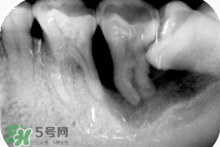 智齒會(huì)引起耳鳴嗎？耳鳴跟智齒有關(guān)系嗎？