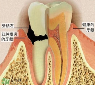 牙結石是什么？牙結石圖片