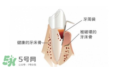 牙周炎怎么治療？牙周炎怎么治好