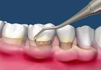 牙周炎怎么治療效果最好？牙周炎怎么治療小偏方