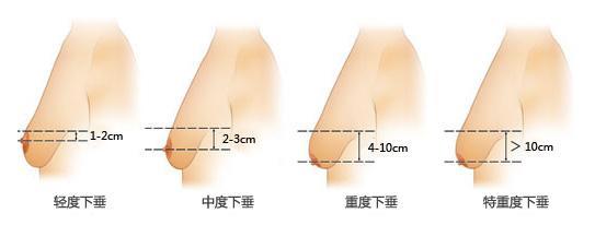 穿文胸能防止下垂嗎 胸罩能防止乳房下垂嗎