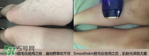 smoothskin和slikn infinity哪個(gè)好？smoothskin脫毛儀怎么樣